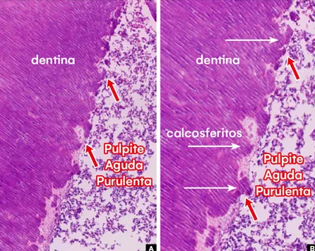 Importância dos calcosferitos na parede dentinária